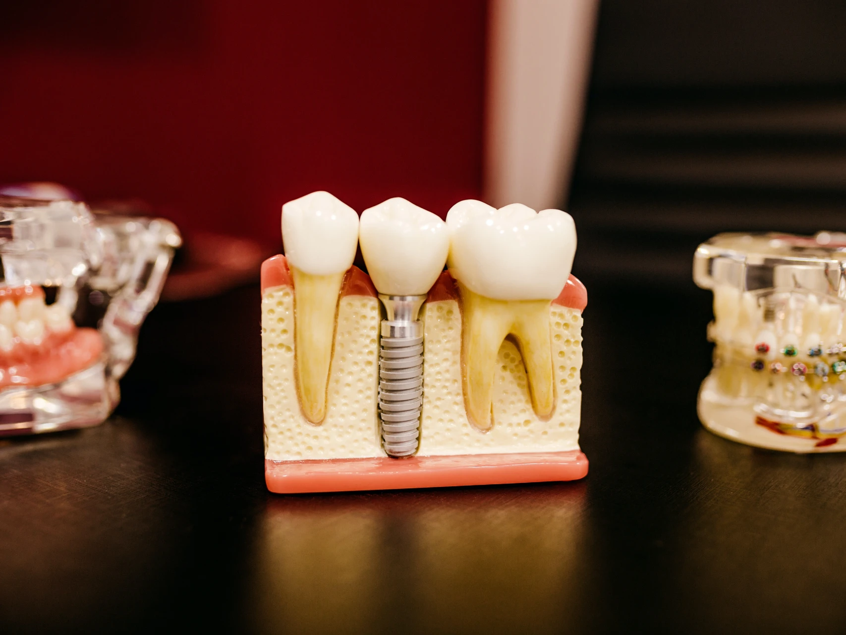 model of a single tooth dental implant | cost of dental implants in Reno, NV