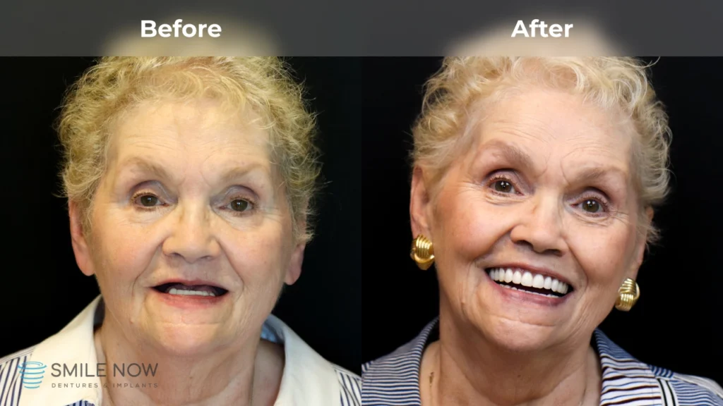 Before and after dental implants in Reno, NV at Smile Now Reno Dentures and Implants
