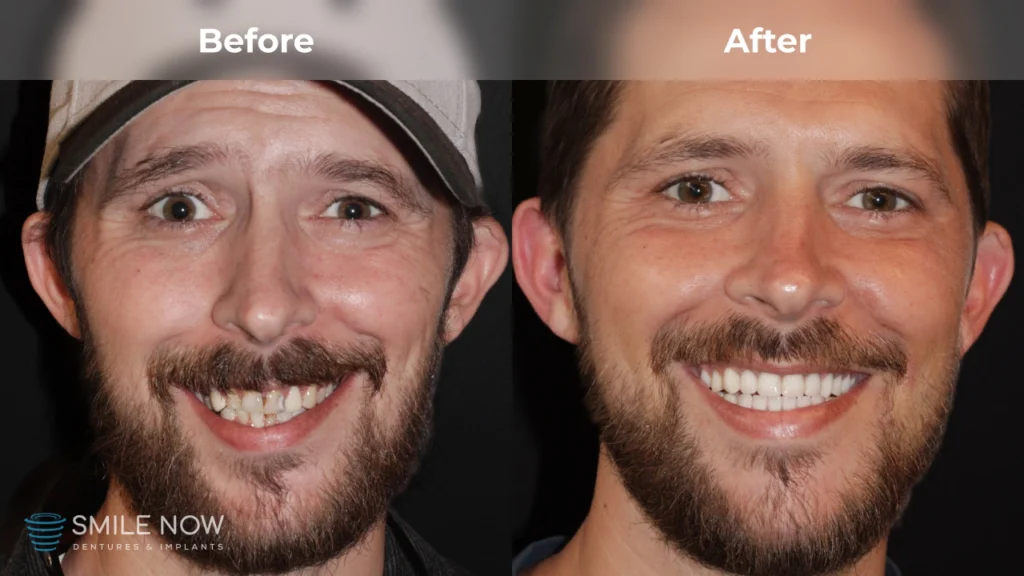 Before and after dental implants in Reno, NV at Smile Now Reno Dentures and Implants
