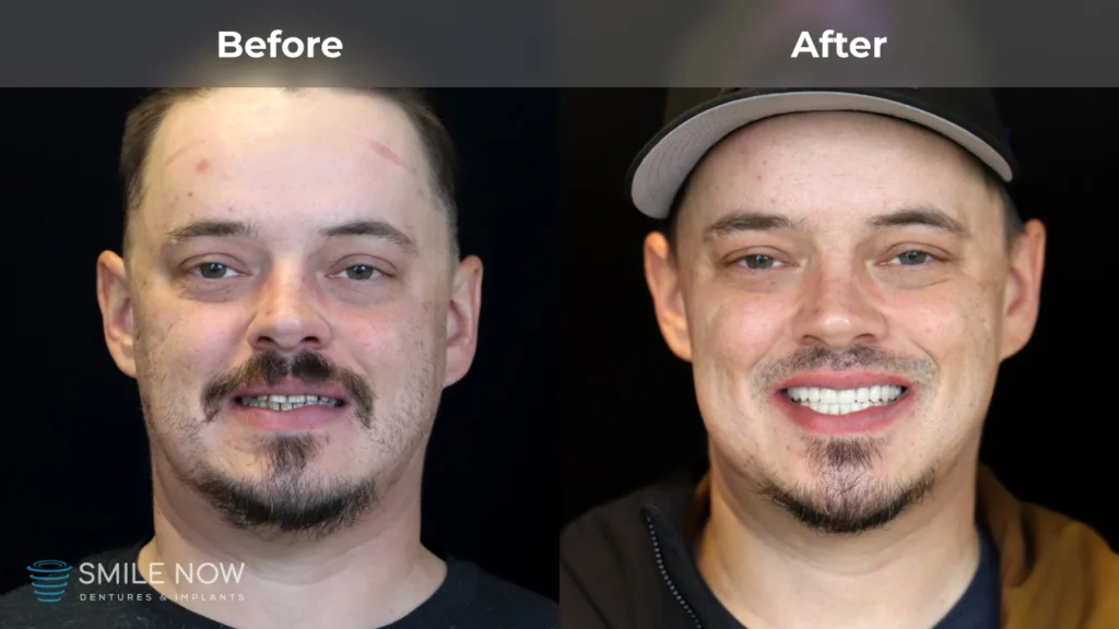 Before and after dental implants in Reno, NV at Smile Now Reno Dentures and Implants