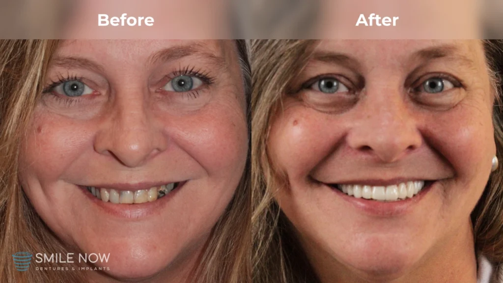 Before and after dental implants in Reno, NV at Smile Now Reno Dentures and Implants