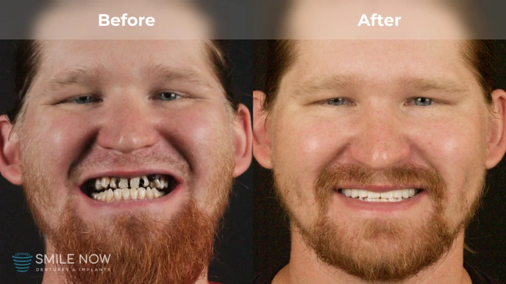 Before and after dental implants in Reno, NV at Smile Now Reno Dentures and Implants