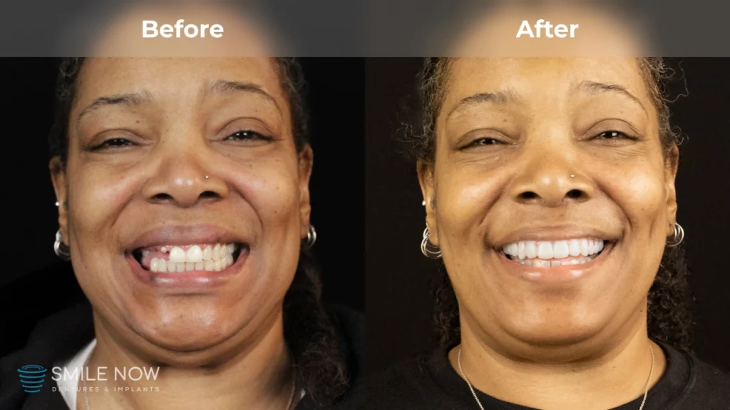Before and after dental implants in Reno, NV at Smile Now Reno Dentures and Implants