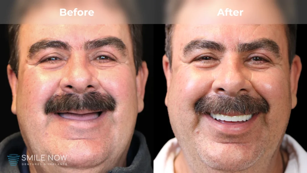 Before and after dental implants in Reno, NV at Smile Now Reno Dentures and Implants