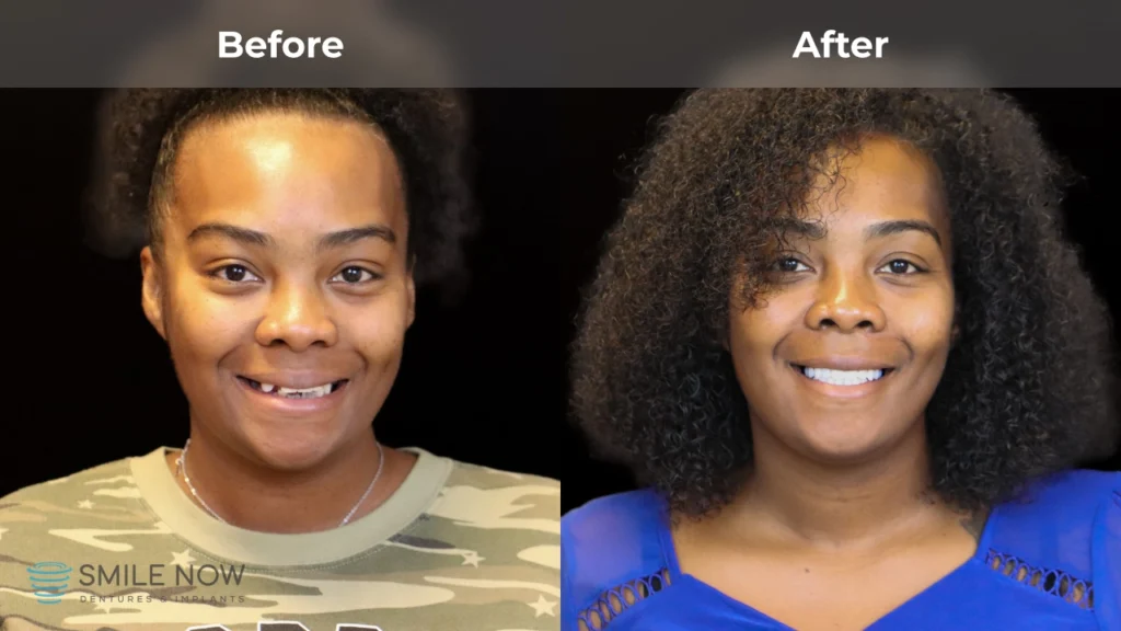 Before and after dental implants in Reno, NV at Smile Now Reno Dentures and Implants