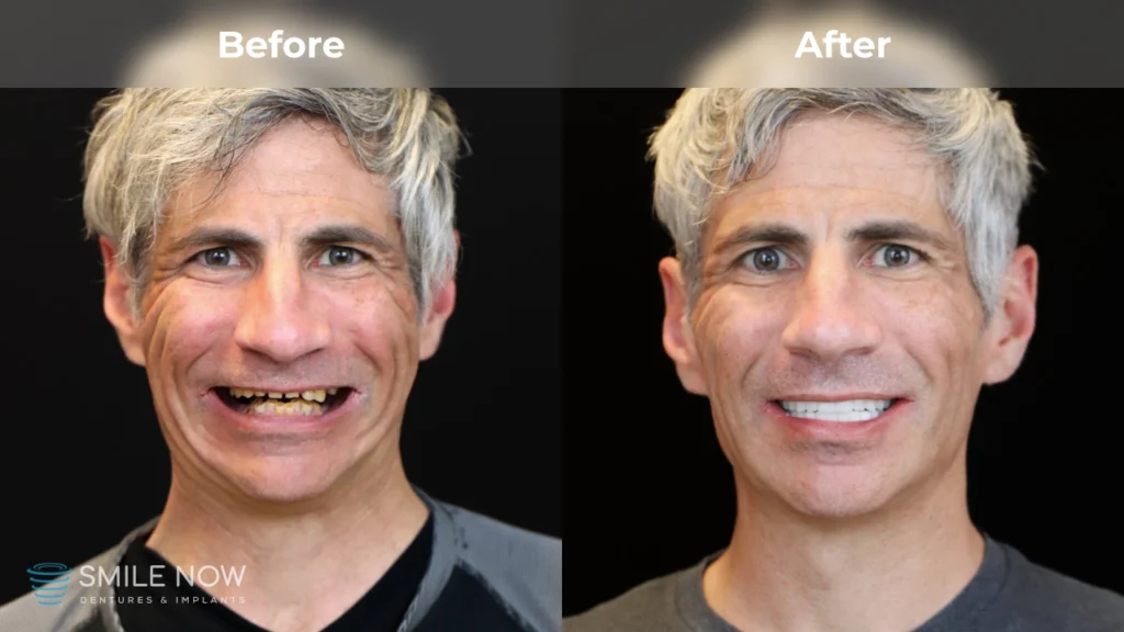 Before and after dental implants in Reno, NV at Smile Now Reno Dentures and Implants