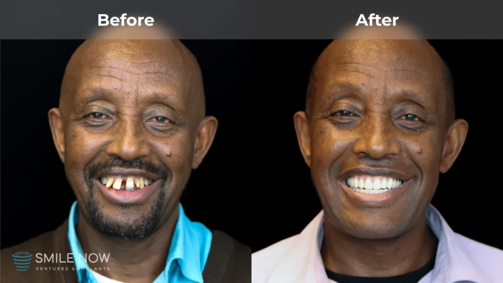 Before and after dental implants in Reno, NV at Smile Now Reno Dentures and Implants