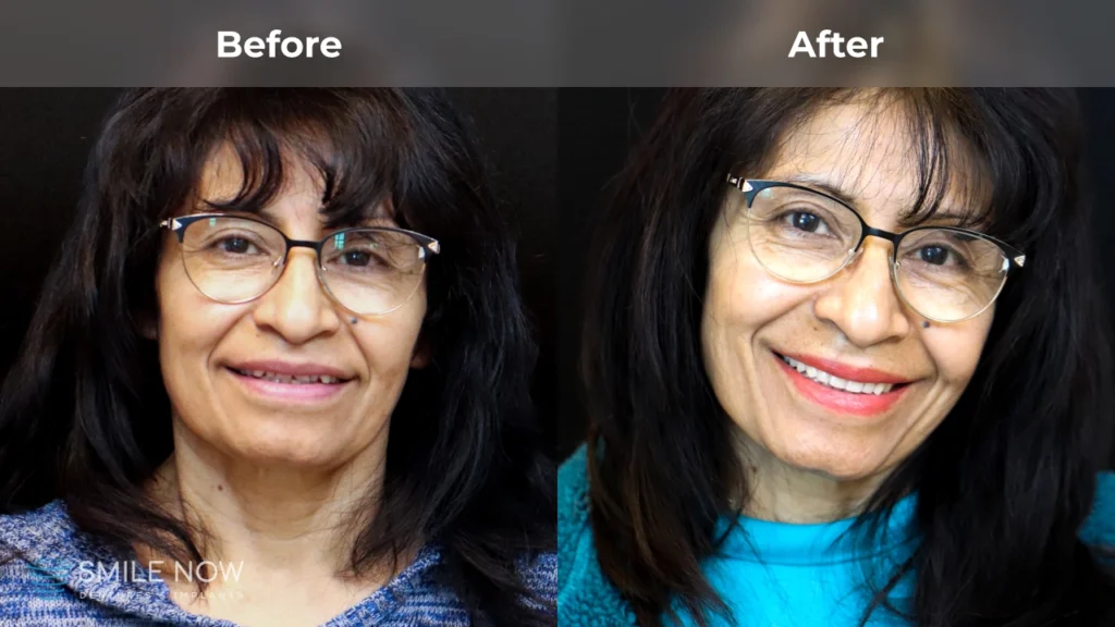 Before and after dental implants in Reno, NV at Smile Now Reno Dentures and Implants