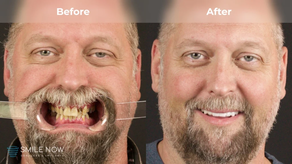 Before and after dental implants in Reno, NV at Smile Now Reno Dentures and Implants