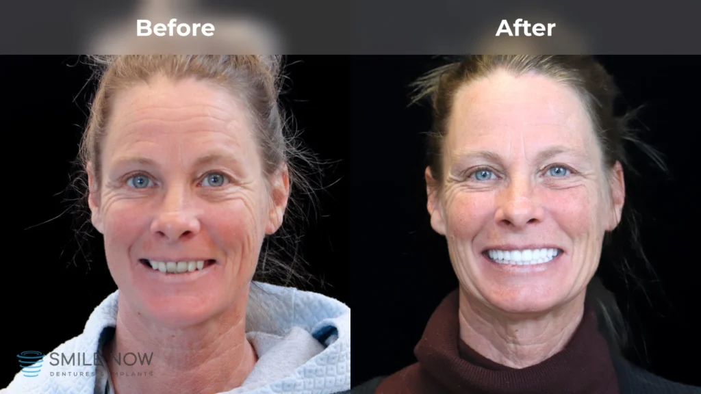 Before and after dental implants in Reno, NV at Smile Now Reno Dentures and Implants