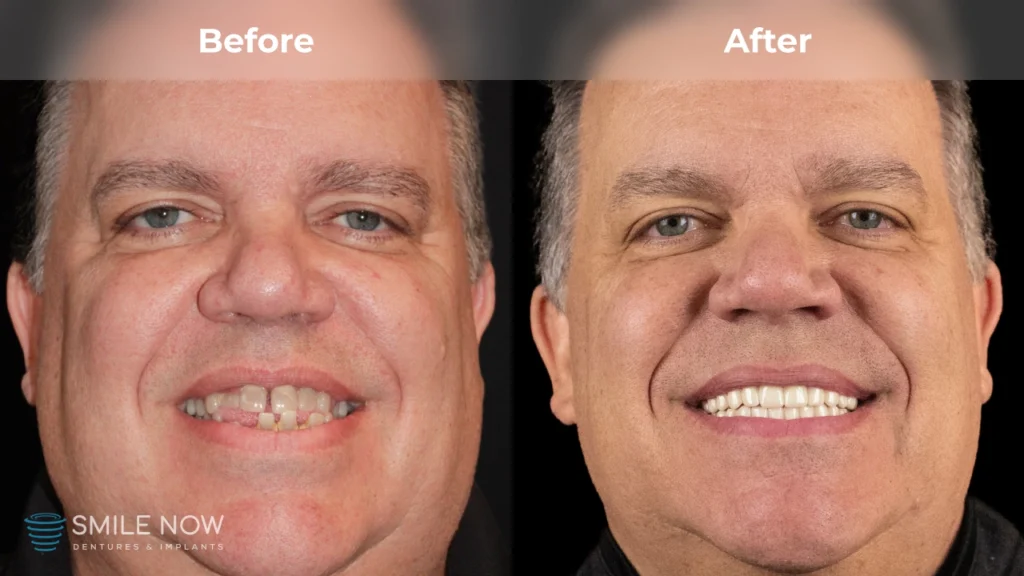 Before and after dental implants in Reno, NV at Smile Now Reno Dentures and Implants