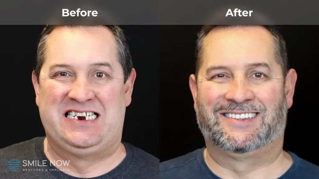 Before and after dental implants in Reno, NV at Smile Now Reno Dentures and Implants