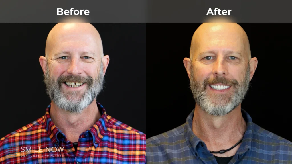 Before and after dental implants in Reno, NV at Smile Now Reno Dentures and Implants