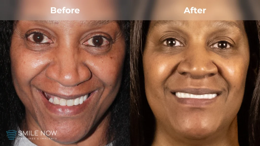 Before and after dental implants in Reno, NV at Smile Now Reno Dentures and Implants