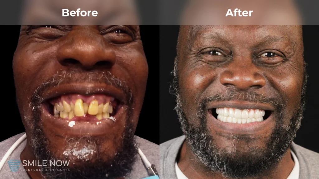 Before and after dental implants in Reno, NV at Smile Now Reno Dentures and Implants