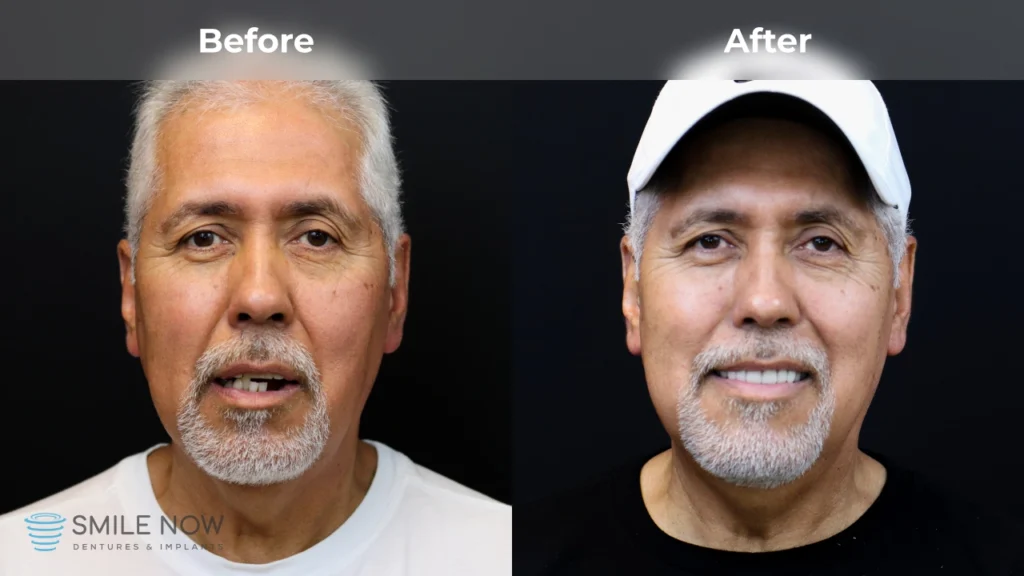 Before and after dental implants in Reno, NV at Smile Now Reno Dentures and Implants