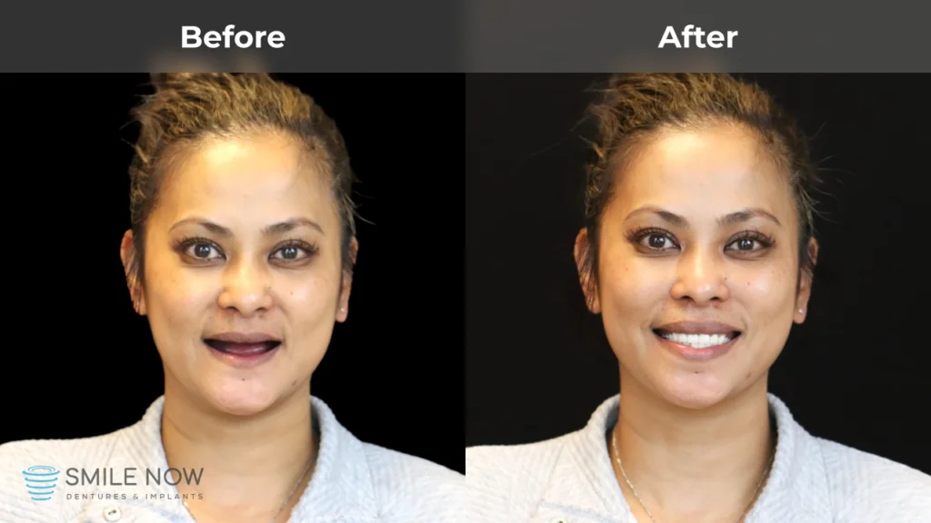 Before and after dental implants in Reno, NV at Smile Now Reno Dentures and Implants