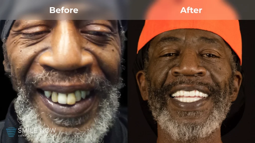 Before and after dental implants in Reno, NV at Smile Now Reno Dentures and Implants