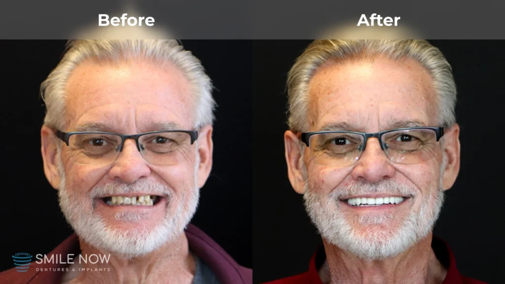 Before and after dental implants in Reno, NV at Smile Now Reno Dentures and Implants