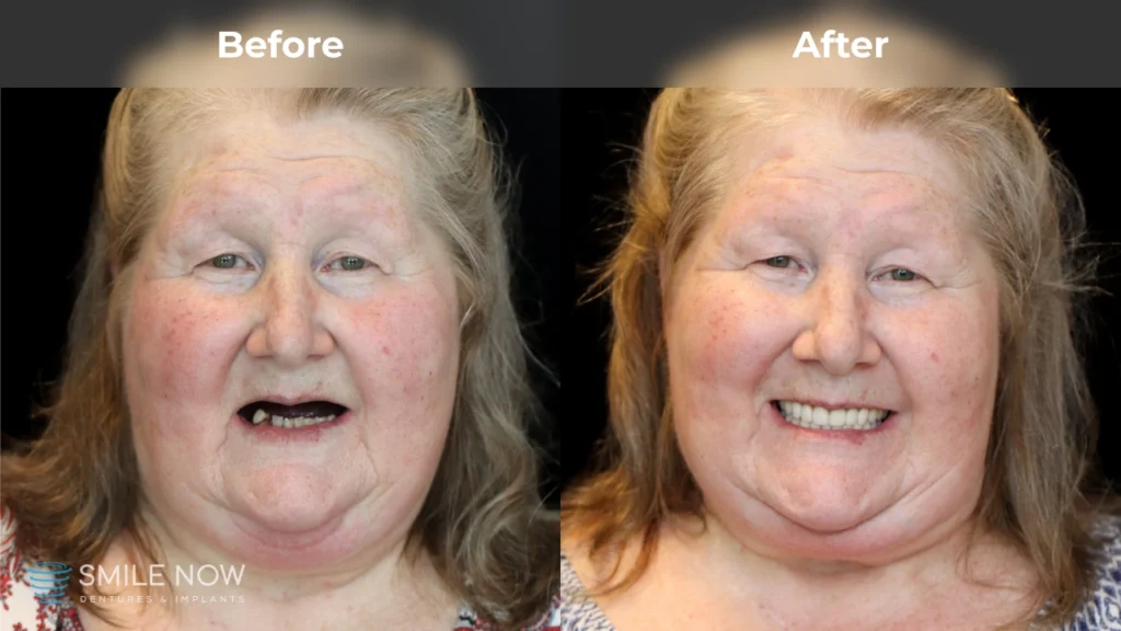 Before and after dental implants in Reno, NV at Smile Now Reno Dentures and Implants