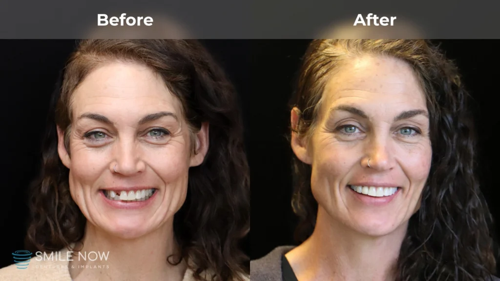 Before and after dental implants in Reno, NV at Smile Now Reno Dentures and Implants