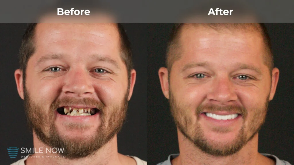 Before and after dental implants in Reno, NV at Smile Now Reno Dentures and Implants