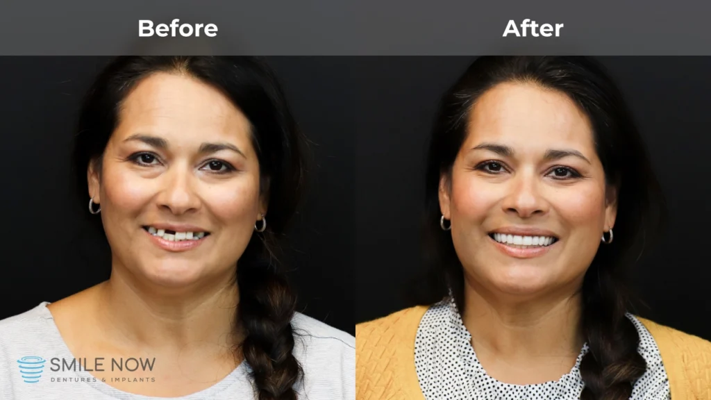 Before and after dental implants in Reno, NV at Smile Now Reno Dentures and Implants