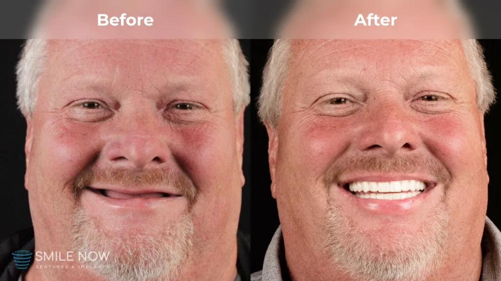 Before and after dental implants in Reno, NV at Smile Now Reno Dentures and Implants