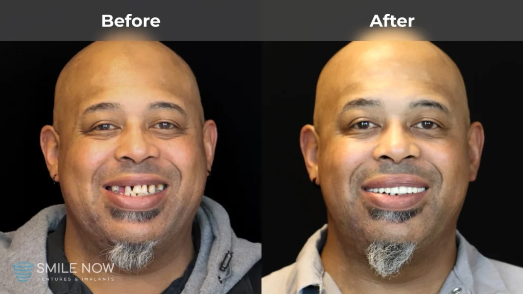 Before and after dental implants in Reno, NV at Smile Now Reno Dentures and Implants