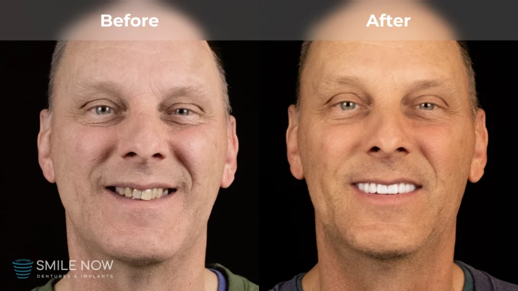Before and after dental implants in Reno, NV at Smile Now Reno Dentures and Implants