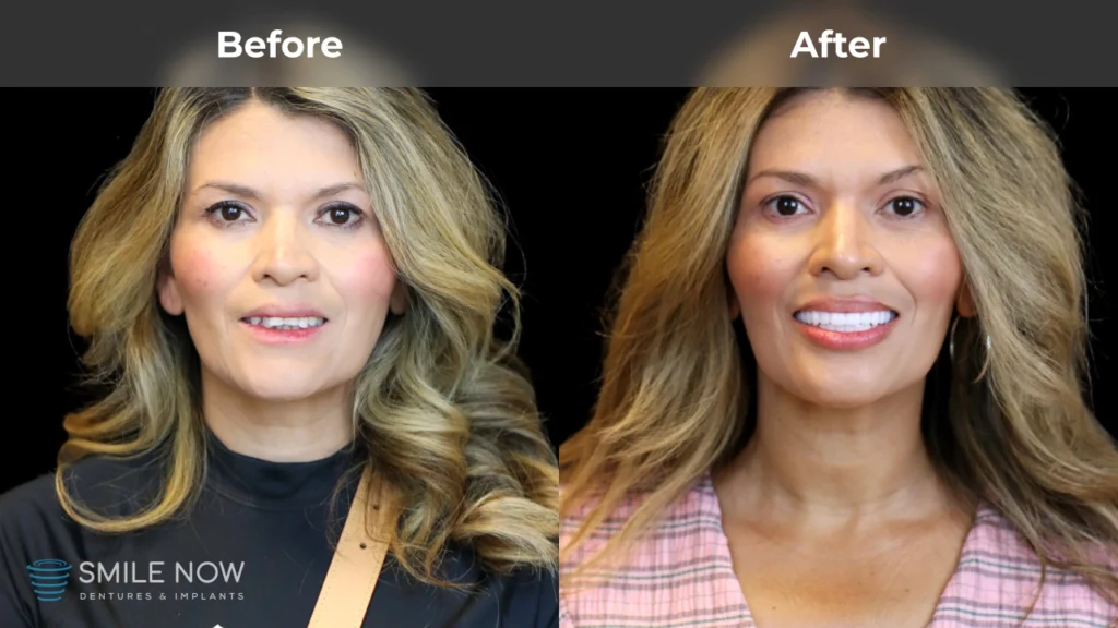 Before and after dental implants in Reno, NV at Smile Now Reno Dentures and Implants