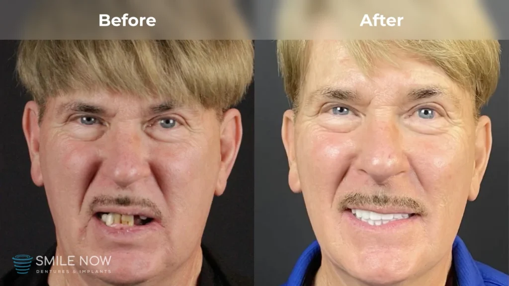 Before and after dental implants in Reno, NV at Smile Now Reno Dentures and Implants