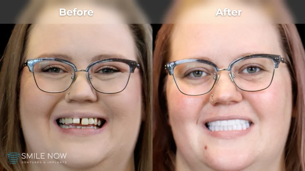 Before and after dental implants in Reno, NV at Smile Now Reno Dentures and Implants