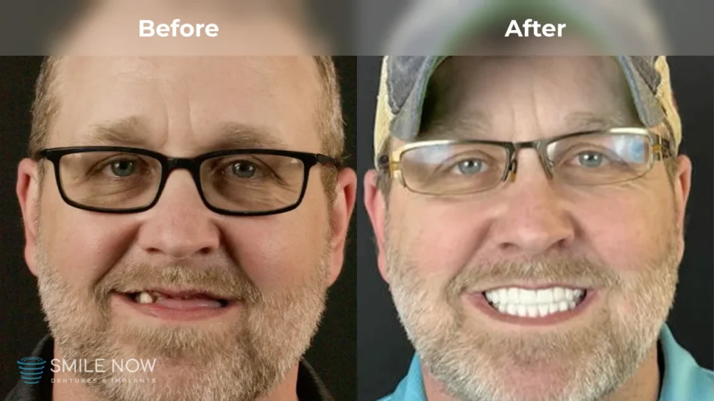 Before and after dental implants in Reno, NV at Smile Now Reno Dentures and Implants