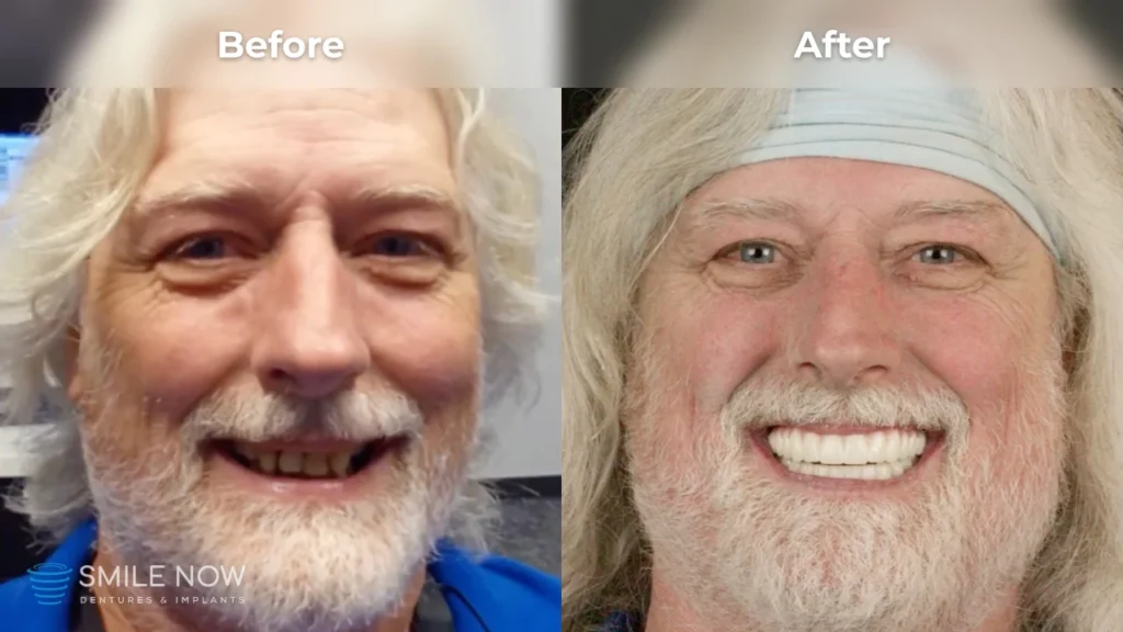 Before and after dental implants in Reno, NV at Smile Now Reno Dentures and Implants