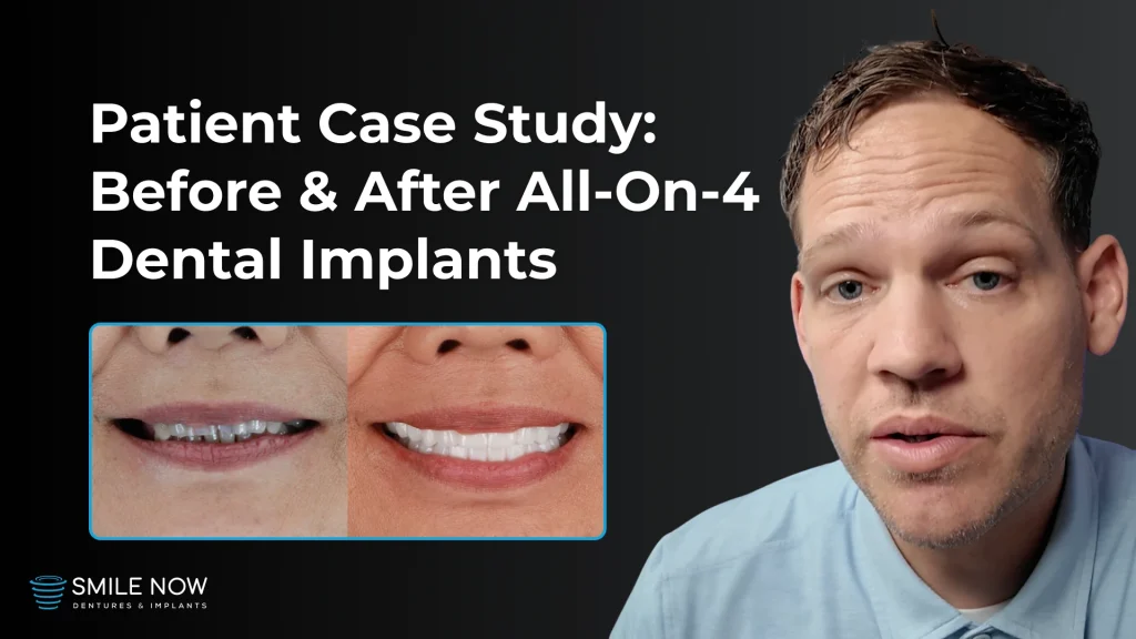 Thumbnail for a video about a patient case study before and after all on 4 dental implants.