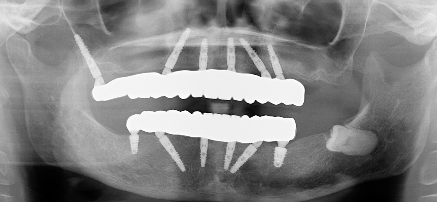 A panoramic x-ray showing a patient after all on 6 dental implants.