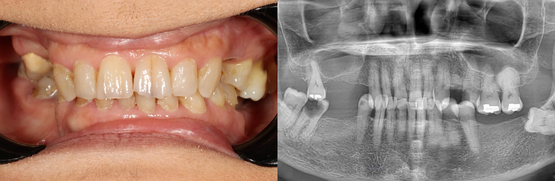 A patient's smile before all on 4 dental implants, including a panoramic x-ray showing missing teeth and decay.